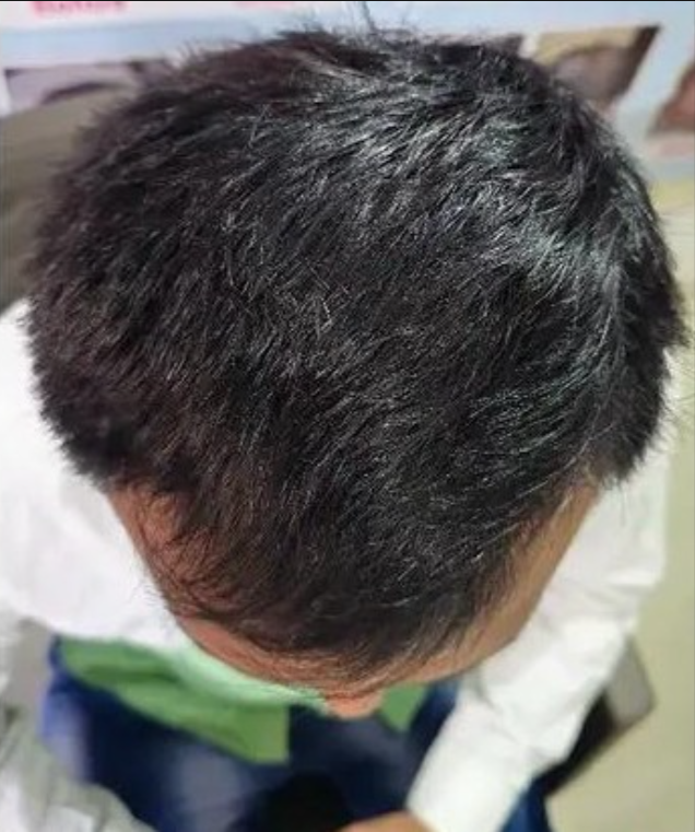 Naturally Designed Scalp Therapy for Healthy Scalp - After