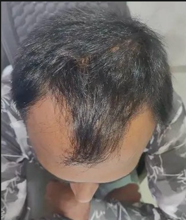 Naturally Designed Scalp Therapy for Healthy Scalp - Before