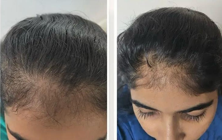 2 Scalp Reset Serum & 1 Scalp Reboot Hair Oil Combo