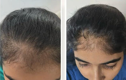 2 Scalp Reset Serum & 1 Scalp Reboot Hair Oil Combo