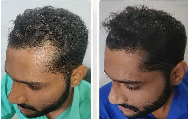 3 Scalp Reset Serum & 1 Scalp Reboot Hair Oil Combo